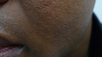 Ice pick scarring remains from